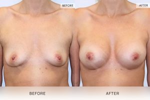 Dr Eddy Dona, Specialist Plastic Surgeon Bella Vista, Sydney, breast augmentation before and after 1