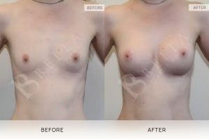 Breast Augmentation 10 - 9
