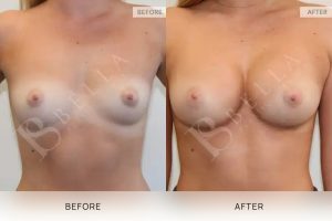Breast Augmentation 11 - 10