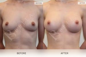 Breast Augmentation 12 - 11