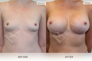 Breast Augmentation 13 - 12
