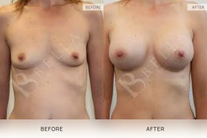 Breast Augmentation 14 - 13