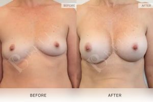 Breast Augmentation 15 - 14