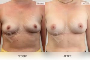 Breast Augmentation 16 - 15