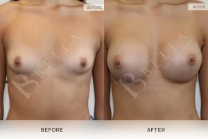 Breast Augmentation 17 - 16