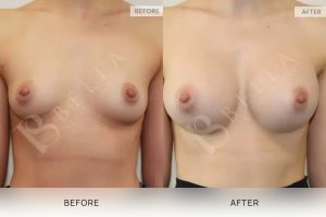 Breast Augmentation 18 - 17