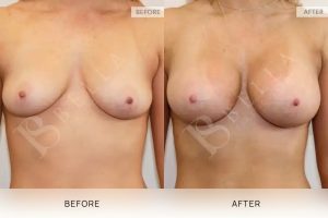 Breast Augmentation 19 - 18