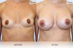 Breast Augmentation 02 - 1