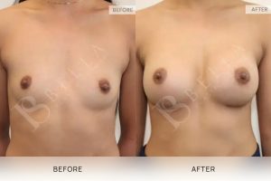 Breast Augmentation 20 - 19