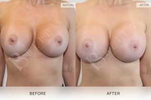 Breast Augmentation 21 - 20