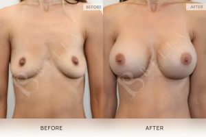 Breast Augmentation 22 - 21