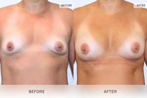 Breast Augmentation 03 - 2