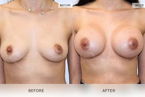 Breast Augmentation 04 - 3