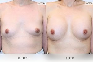 Breast Augmentation 05 - 4