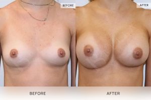 Breast Augmentation 06 - 5