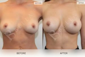 Breast Augmentation 07 - 6