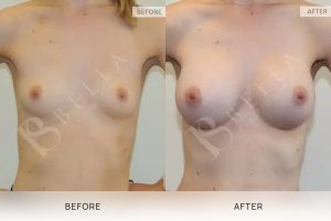 Breast Augmentation 08 - 7