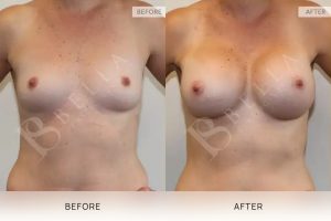 Breast Augmentation 09 - 8