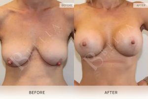 Breast Lift (Mastopexy) + Implants Patient 01 1 Breast Lift (Mastopexy) + Implants Patient 01 - 1