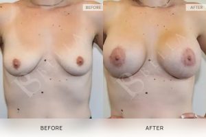 Breast Lift (Mastopexy) + Implants Patient 02 2 Breast Lift (Mastopexy) + Implants Patient 02 - 2