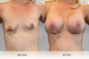 Breast Lift (Mastopexy) + Implants Patient 03 3 Breast Lift (Mastopexy) + Implants Patient 03 - 3