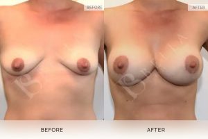 Breast Lift (Mastopexy) + Implants Patient 04 4 Breast Lift (Mastopexy) + Implants Patient 04 - 4