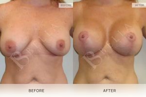 Breast Lift (Mastopexy) + Implants Patient 05 5 Breast Lift (Mastopexy) + Implants Patient 05 - 5