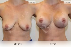 Breast Lift (Mastopexy) + Implants Patient 06 6 Breast Lift (Mastopexy) + Implants Patient 06 - 6