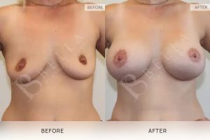 Breast Lift (Mastopexy) + Implants Patient 07 7 Breast Lift (Mastopexy) + Implants Patient 07 - 7
