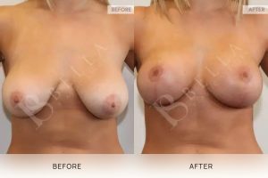 Breast Lift (Mastopexy) + Implants Patient 08 8 Breast Lift (Mastopexy) + Implants Patient 08 - 8