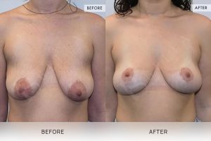 Breast Lift Patient 01 2 Breast Lift Patient 01 - 2