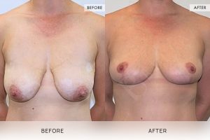 Breast Lift Patient 02 3 Breast Lift Patient 02 - 3