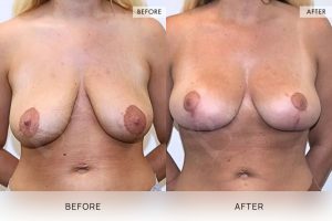 Breast Lift Patient 03 4 Breast Lift Patient 03 - 4