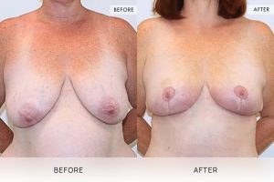 Breast Lift Patient 04 5 Breast Lift Patient 04 - 5