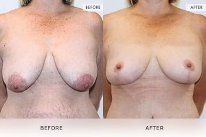 Breast Lift Patient 05 6 Breast Lift Patient 05 - 6
