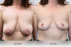 Breast Lift Patient 06 7 Breast Lift Patient 06 - 7