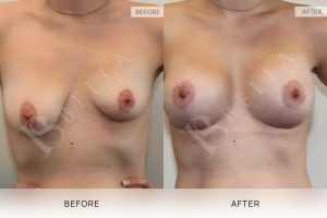Breast Lift Patient 07 8 Breast Lift Patient 07 - 8