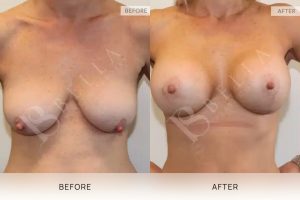 Breast Lift Patient 08 9 Breast Lift Patient 08 - 9