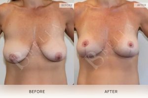 Breast Lift Patient 09 10 Breast Lift Patient 09 - 10