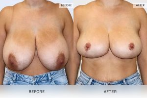 Breast Reduction Patient 01 - 2