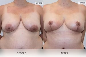 Breast Reduction Patient 10 - 11