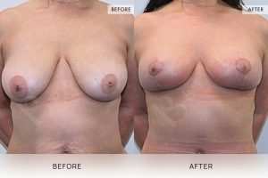 Breast Reduction Patient 11 - 12
