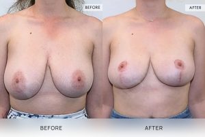 Breast Reduction Patient 12 - 13