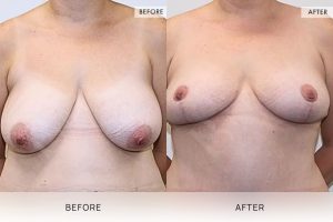 Breast Reduction Patient 13 - 14
