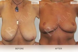 Breast Reduction Patient 14 - 15
