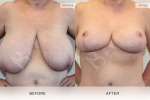 Breast Reduction Patient 15 - 16