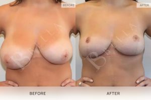 Breast Reduction Patient 16 - 17