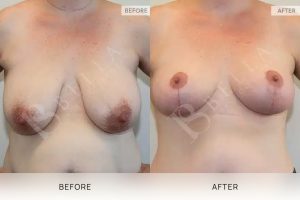 Breast Reduction Patient 17 - 18