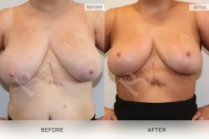 Breast Reduction Patient 18 - 19