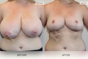 Breast Reduction Patient 19 - 20